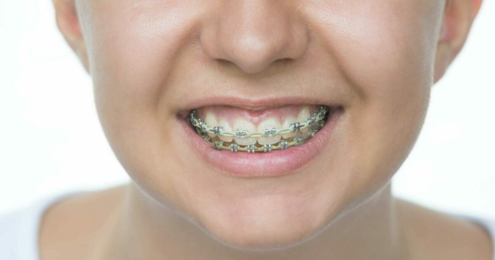 ارتودنسی دندان