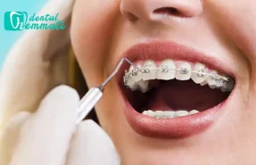 رژیم غذایی مناسب ارتودنسی