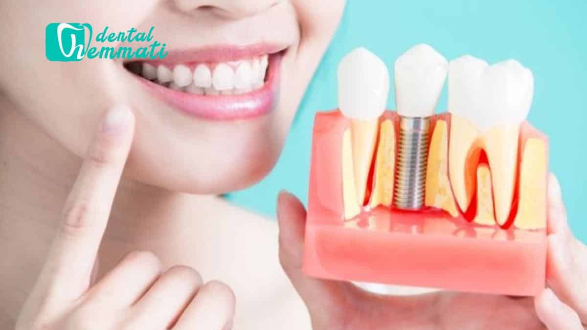 عمر ایمپلنت