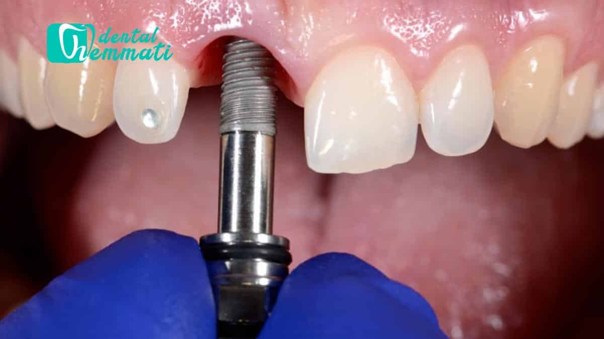 عمر ایمپلنت