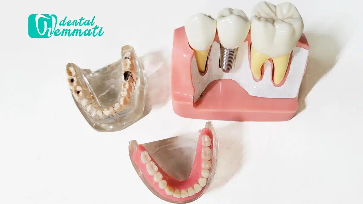 ایمپلنت دندان یا دندان مصنوعی