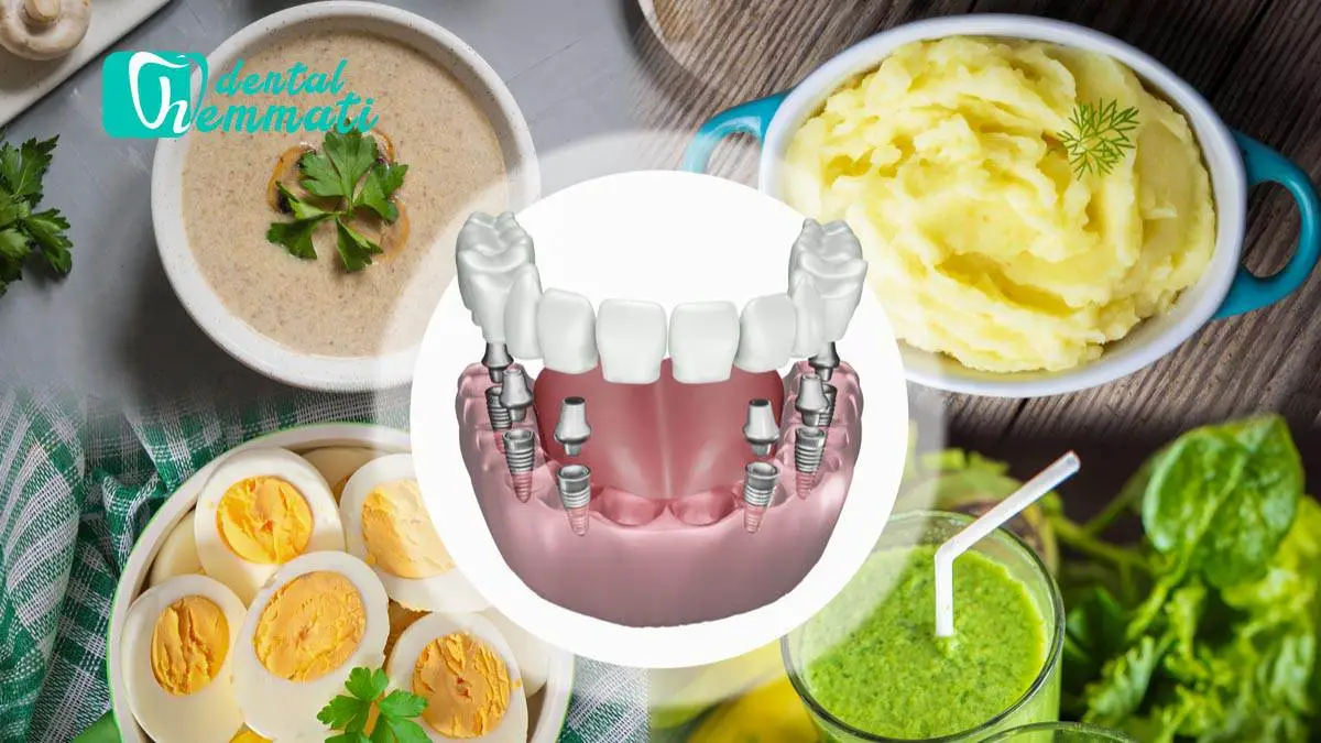 تغذیه بعد از ایمپلنت دندان