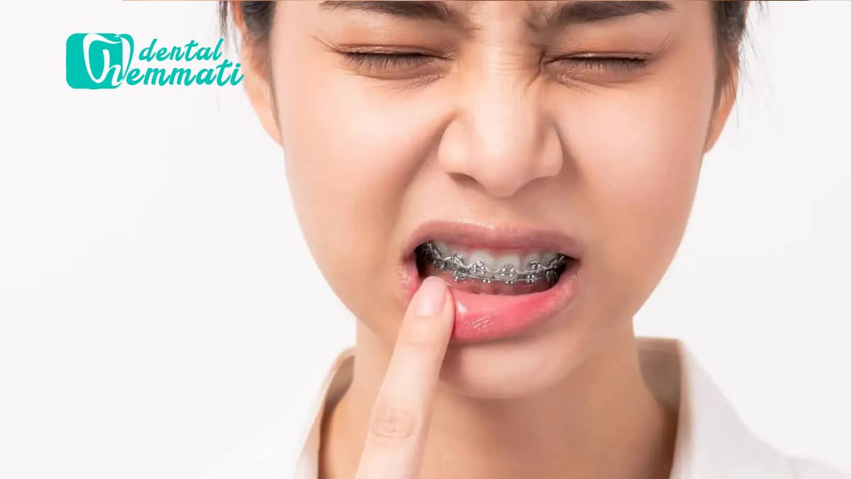 چگونه از شر زخم‌های دهانی ناشی از ارتودنسی خلاص شویم؟