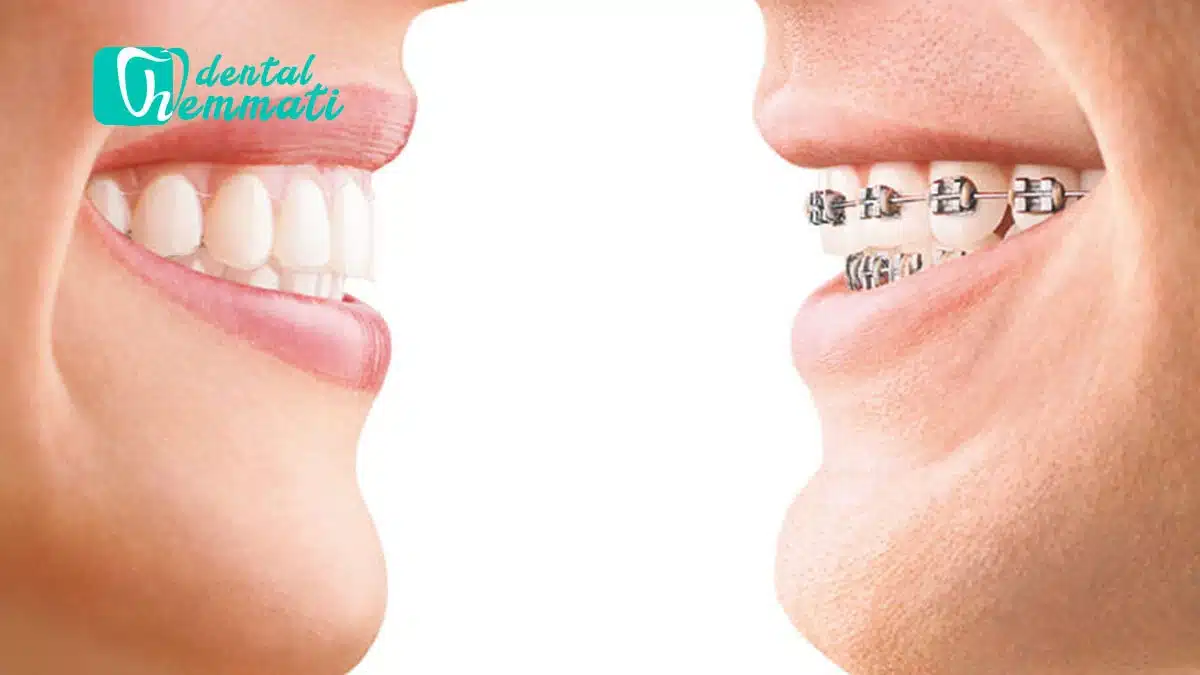 ارتودنسی نامرئی یا ارتودنسی سیمی