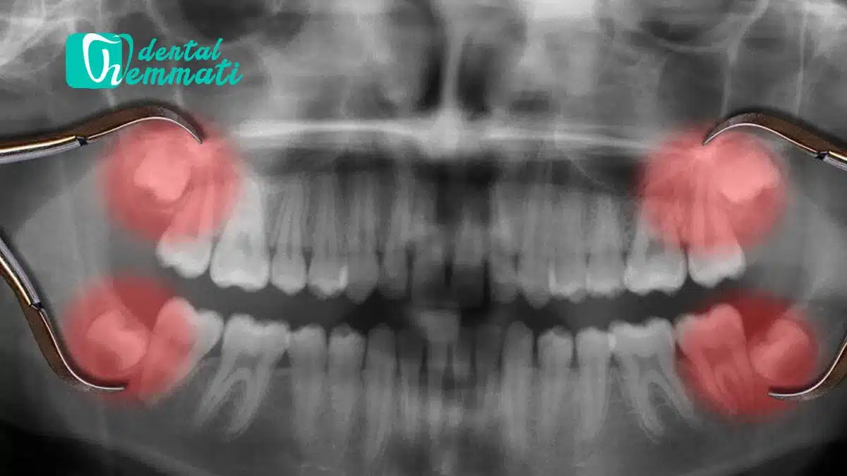 درد دندان های عقل