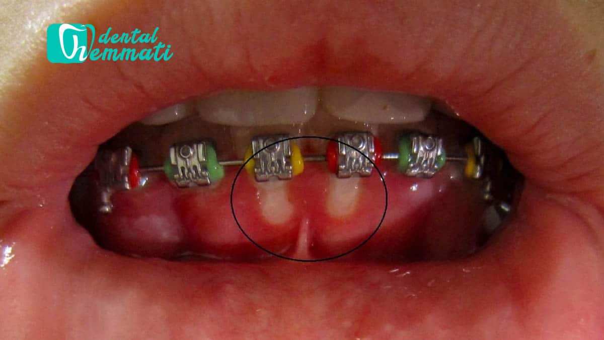 چگونه از شر زخم‌های دهانی ناشی از ارتودنسی خلاص شویم؟