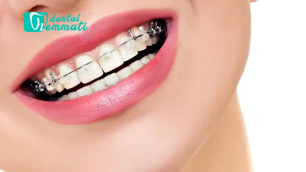 ارتودنسی سیمی