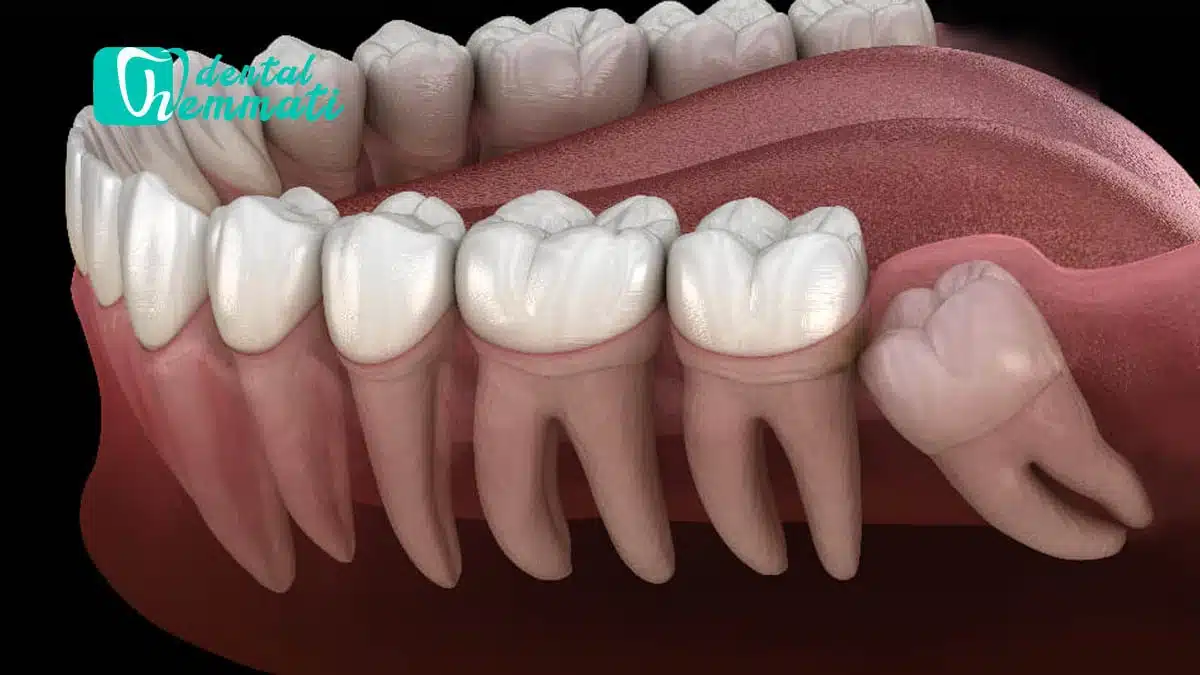 درد دندان های عقل