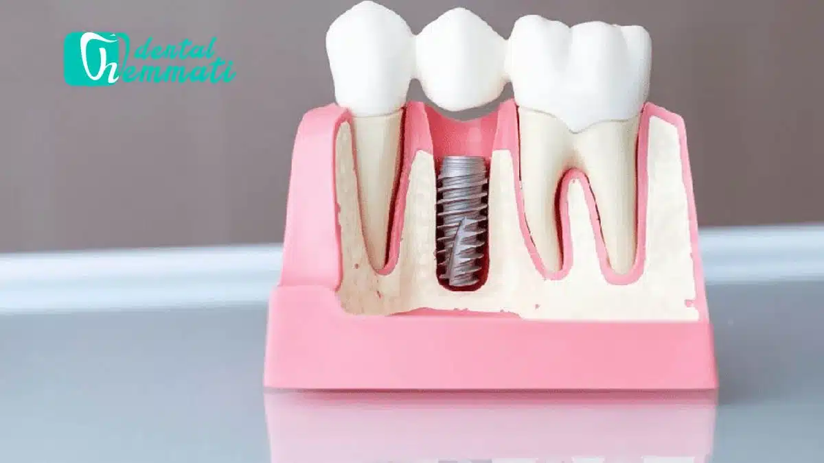 عفونت بعد از ایمپلنت