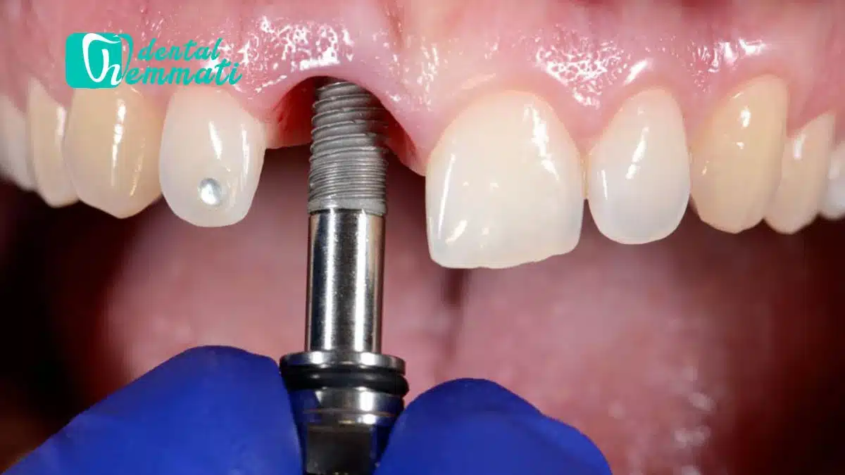 عفونت بعد از ایمپلنت