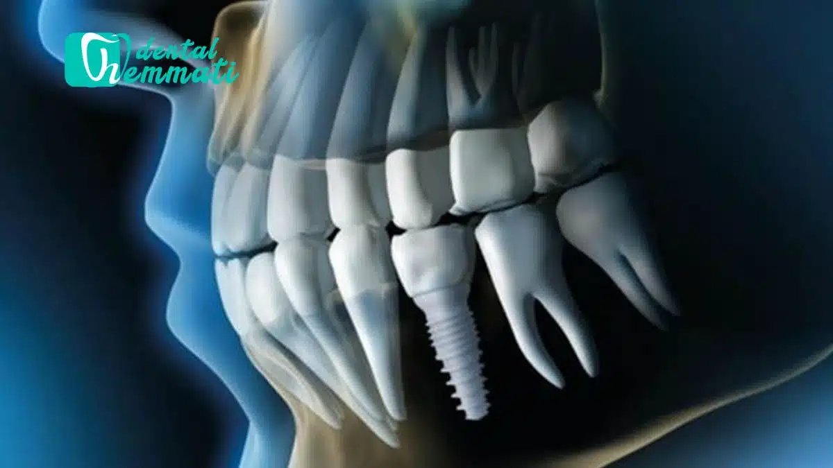 کاشت ایمپلنت و بازسازی استخوان فک