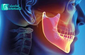 کاشت ایمپلنت و بازسازی استخوان فک