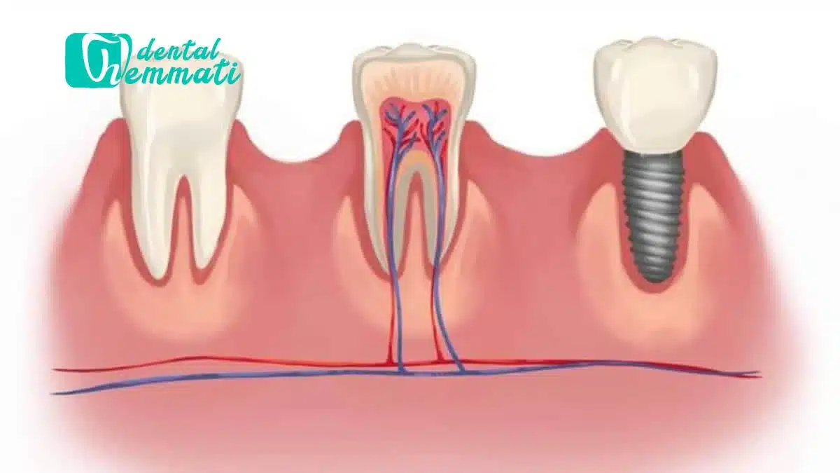 عفونت بعد از ایمپلنت