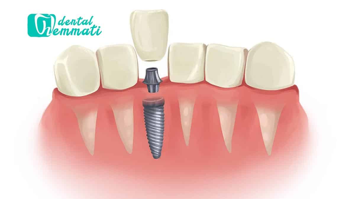 استخوان فک ضعیف