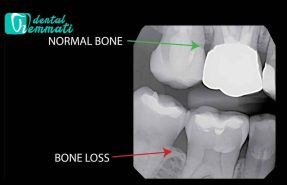 استخوان فک ضعیف