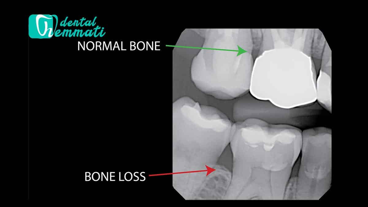استخوان فک ضعیف