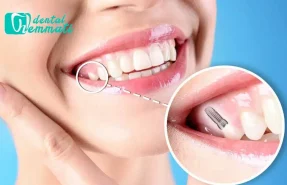 تمیز کردن ایمپلنت