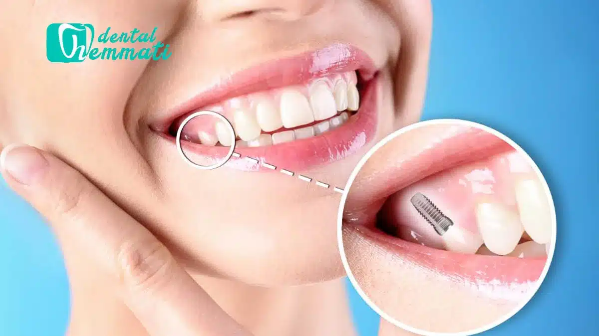 تمیز کردن ایمپلنت