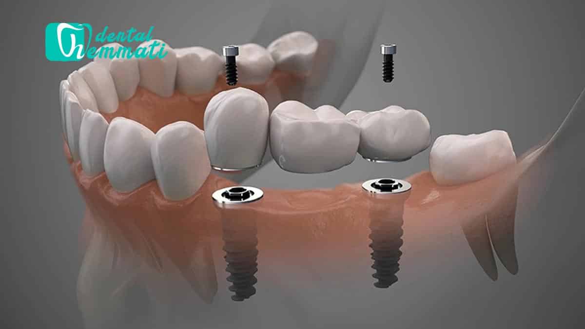 استخوان فک ضعیف